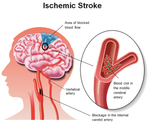 Stroke - Ischemic stroke