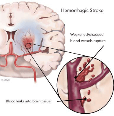 Stroke - Hemorrhagic stroke